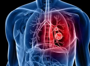 Thoracic Surgery Thoracic Surgery